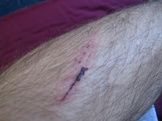 hiking battle scars