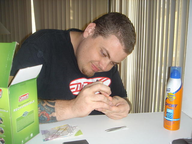 Andrew trying to remove sea urchin splinters from his fingers.