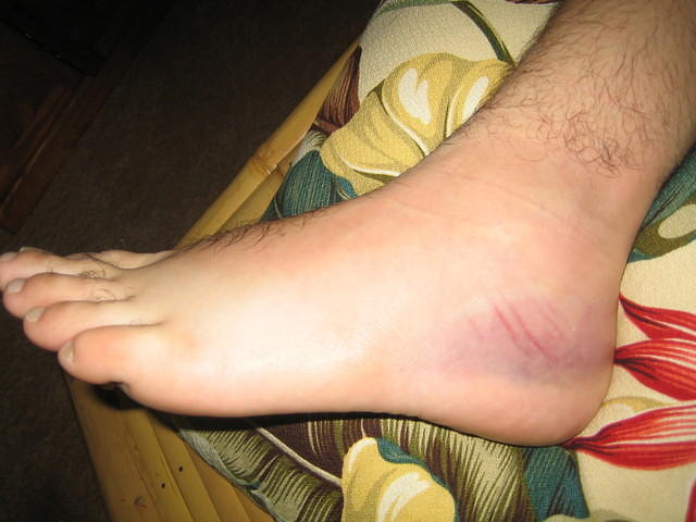 Mickey's swollen and bruised foot